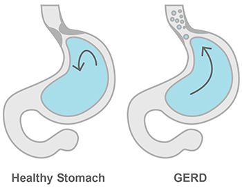 Atypical symptoms of gastroesophageal reflux in pregnancy